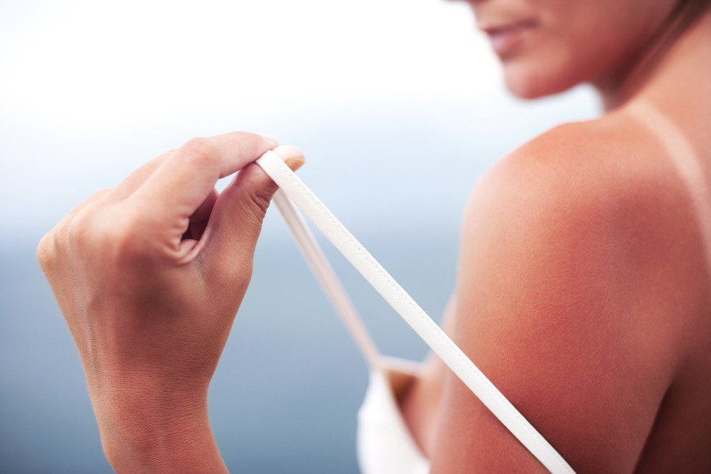 sunburn picture by Marco Marcello via shutterstock